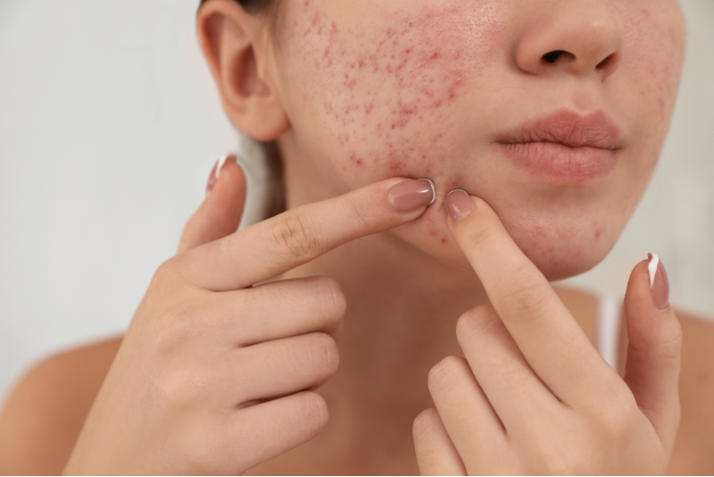 Acne & Pimples