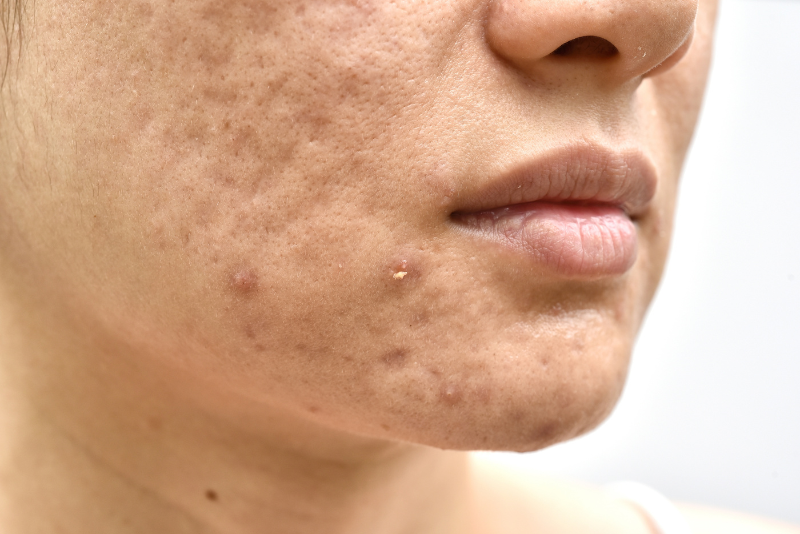 Acne Scars Treatment