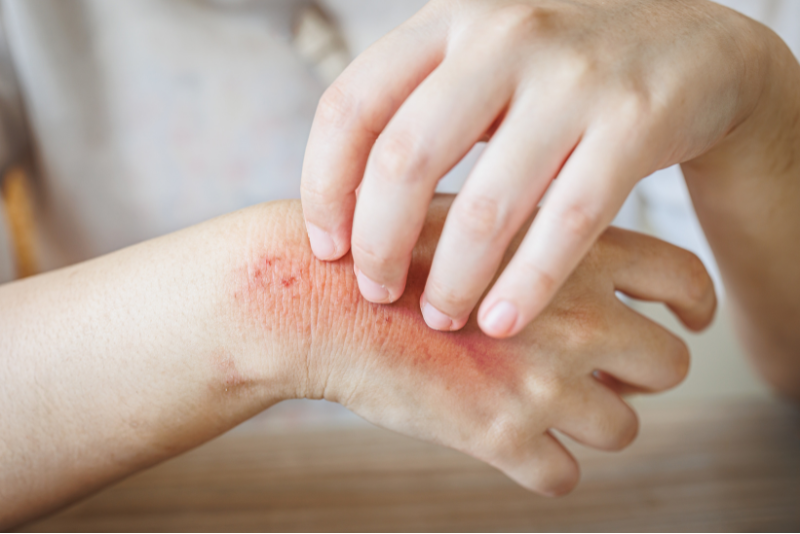 Allergies & Rashes Treatment