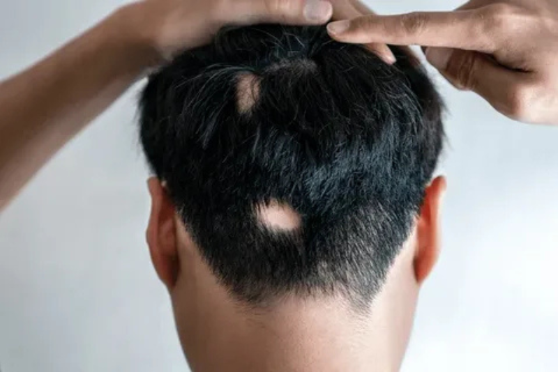 Alopecia Areata