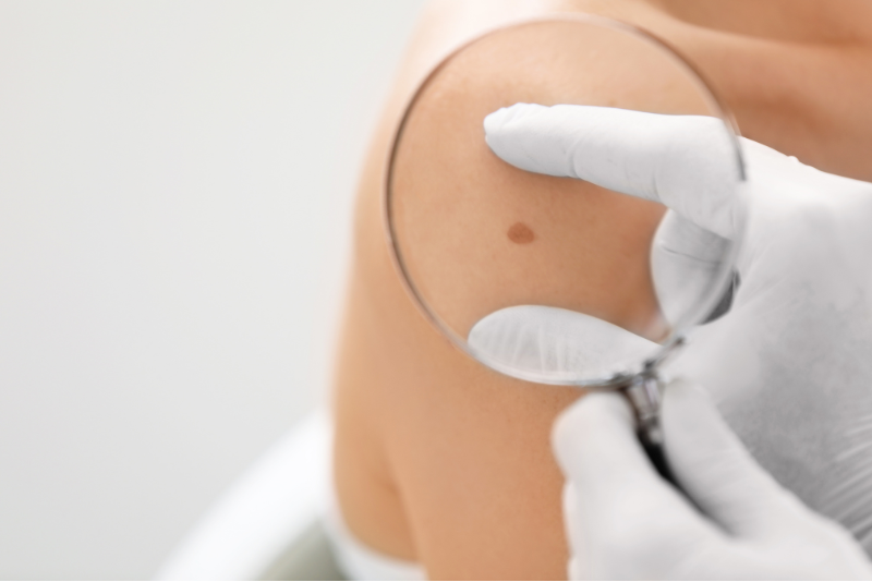 Biopsy & Diagnosis Treatment
