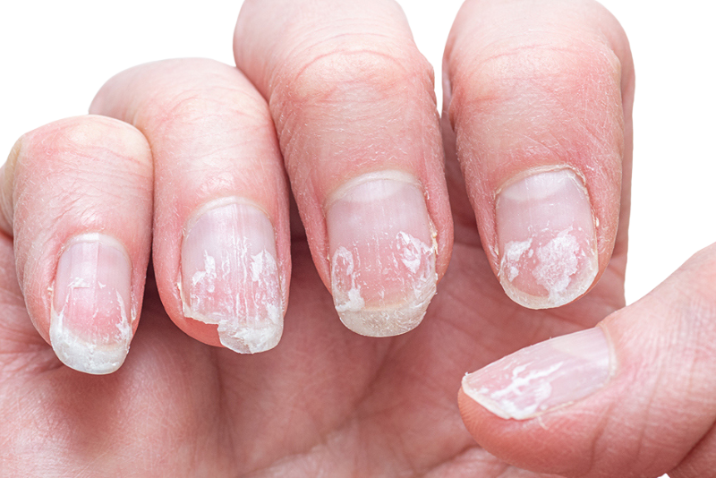 Brittle & Cracked Nails