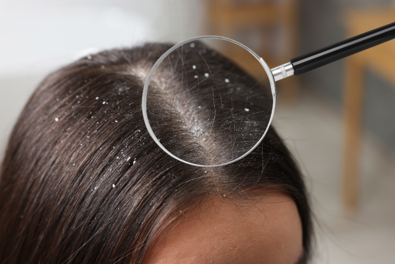 Dandruff & Scalp Issues Treatment