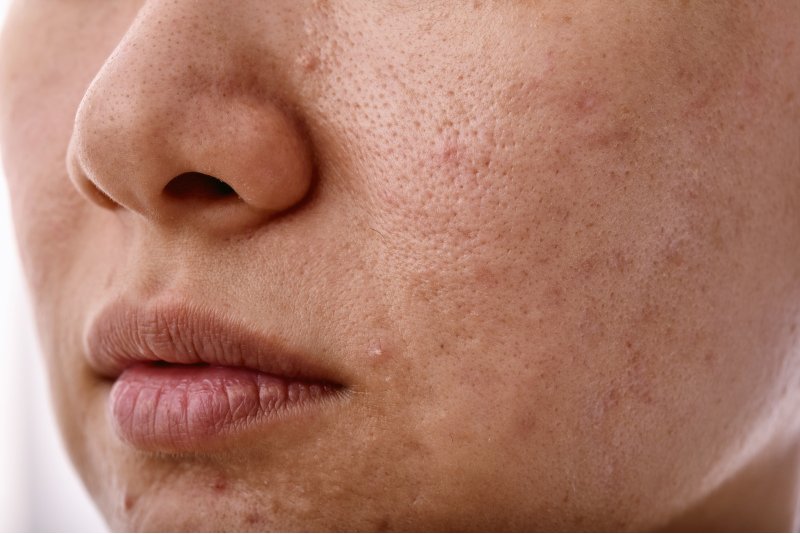 Dull Skin & Uneven Tone Treatment