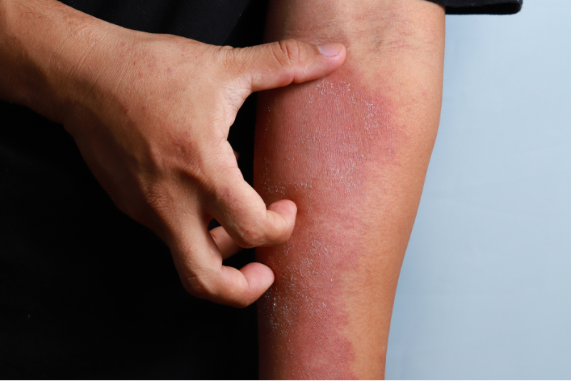 Eczema & Dermatitis