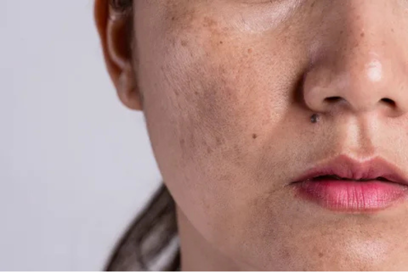 Hyperpigmentation & Melasma