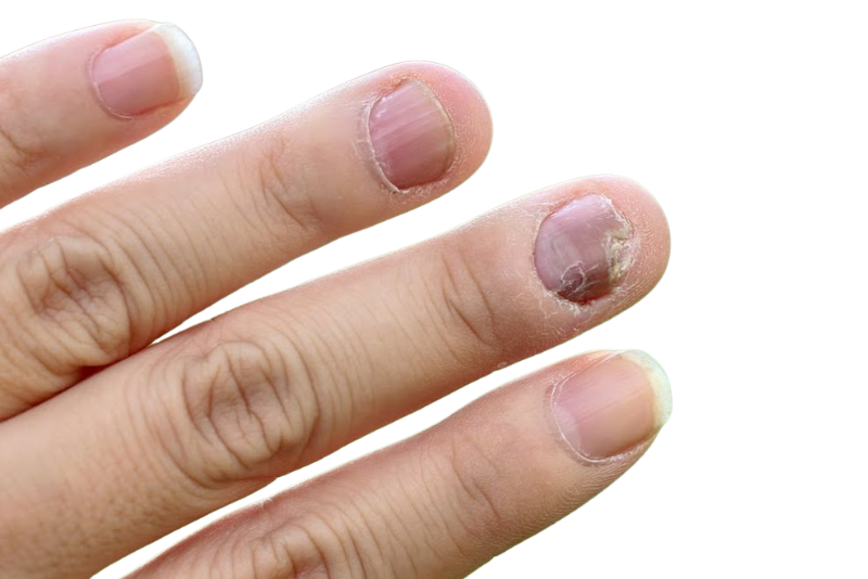 Nail Fungal Infections Treatment