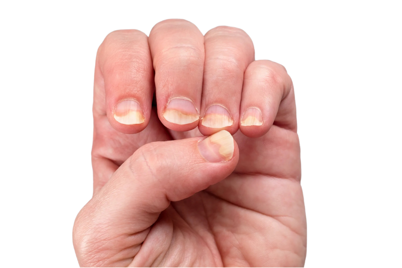 Nail Psoriasis Treatment