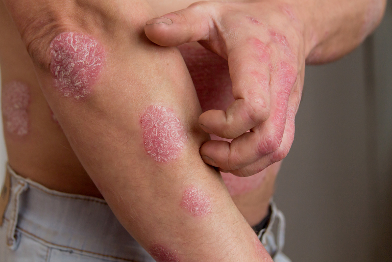 Psoriasis