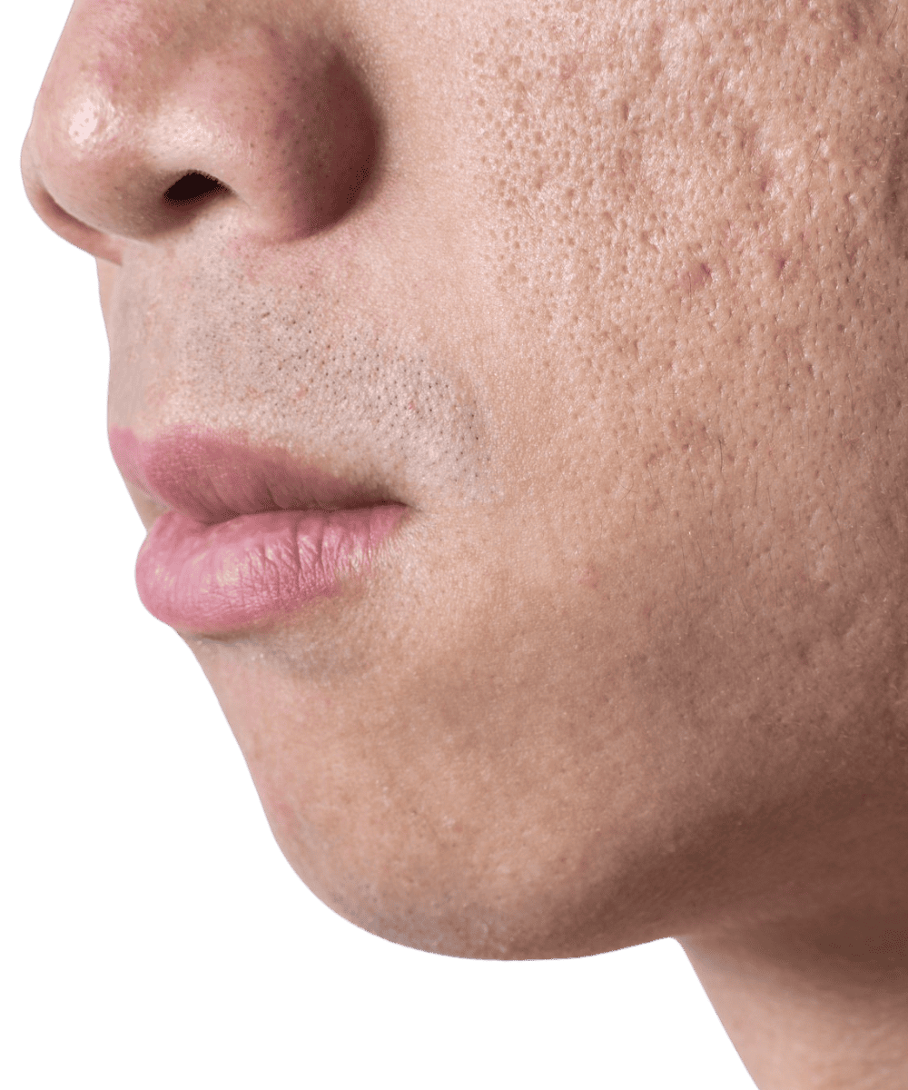 Skin Treatments