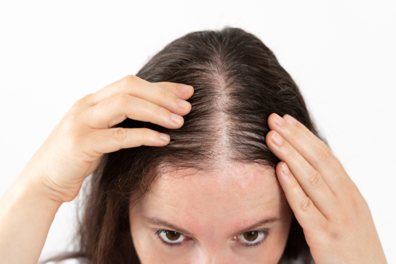Thinning Hair