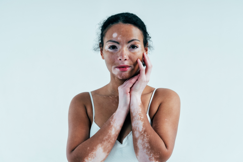 Vitiligo Treatment