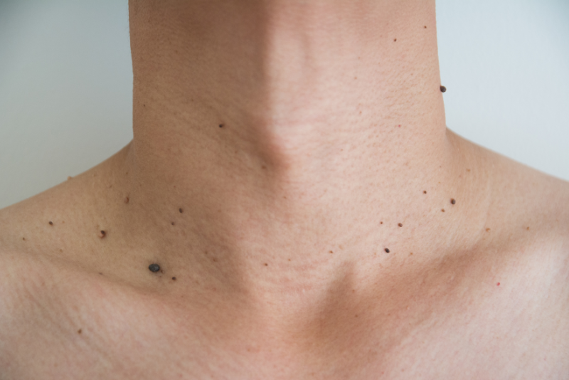 Warts, Moles, Skin Tags Removal