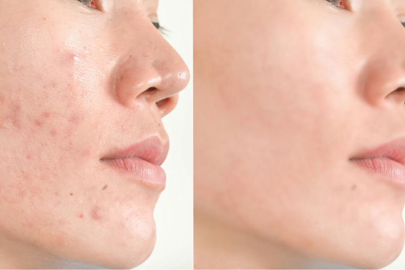 Acne & Pimples Treatment