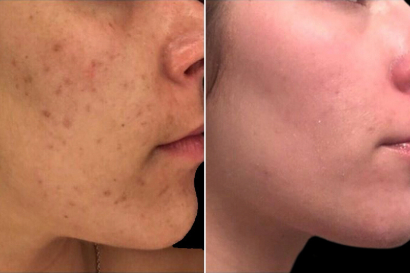 Acne Scars Treatment