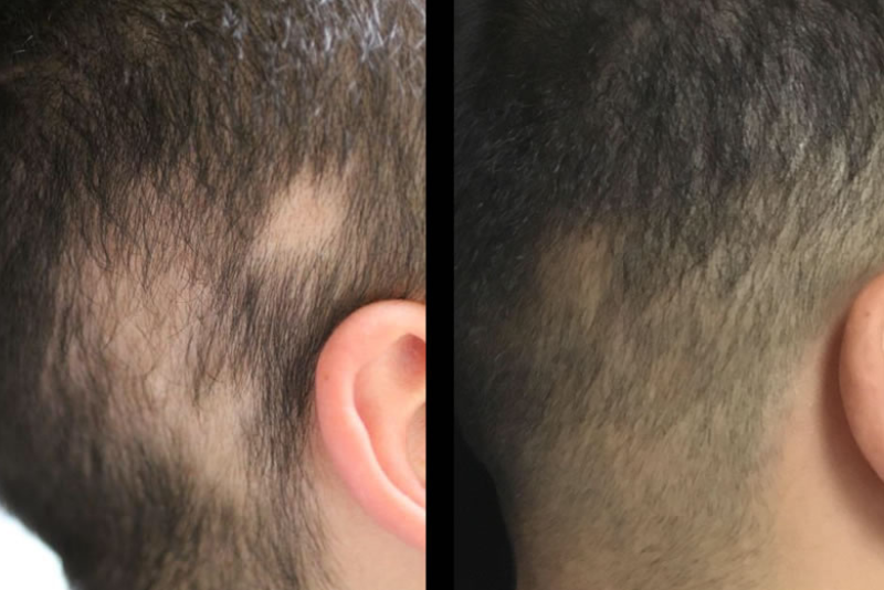Alopecia Areata Treatment