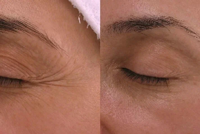 Botox for Wrinkles Treatment