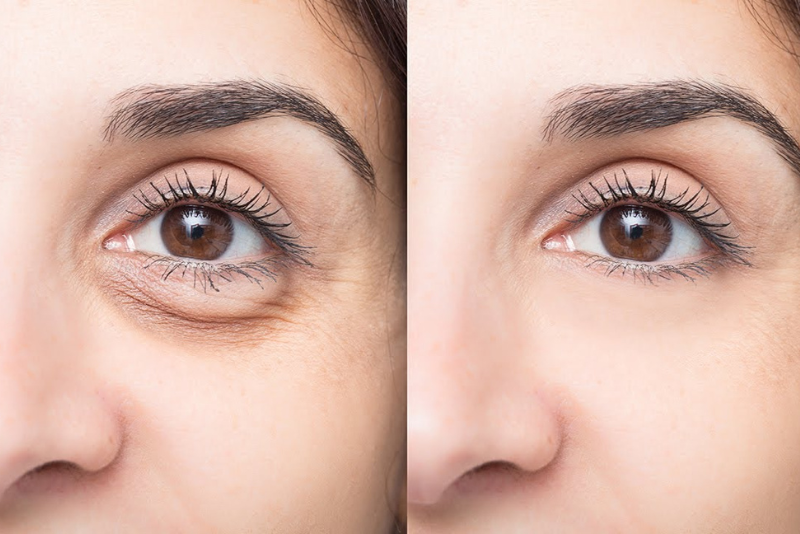 Dark Circles Treatment