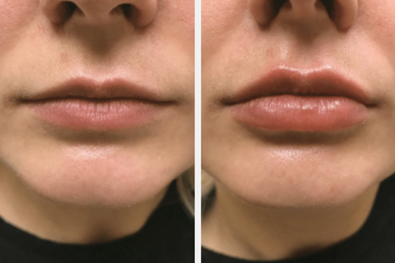Dermal Fillers Treatment