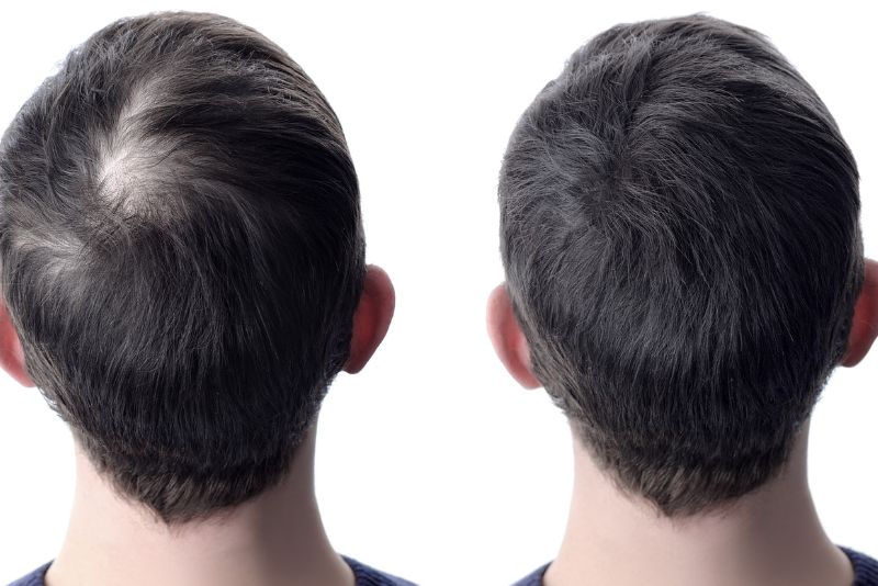 Hair Mesotherapy Treatment