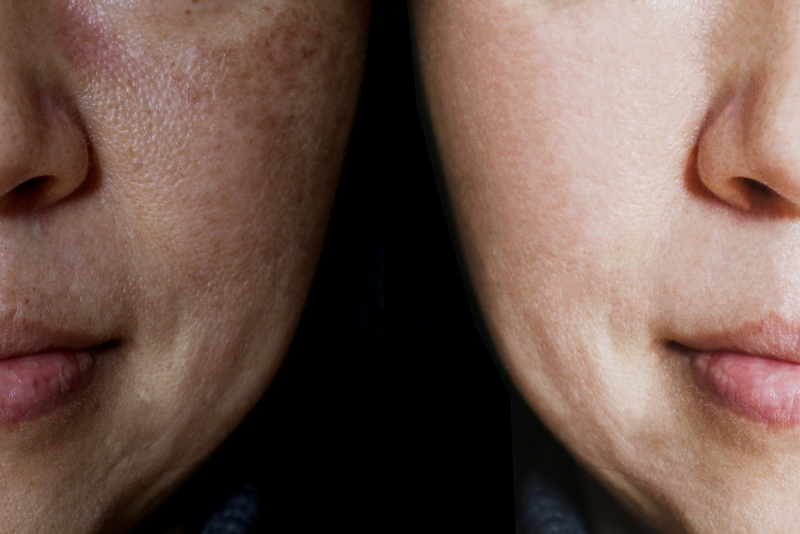 Hyperpigmentation & Melasma Treatment