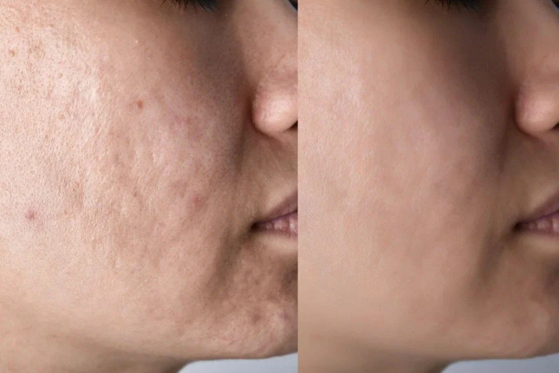 Laser for Acne Scar Treatment