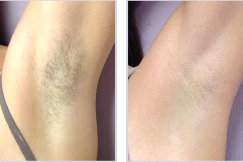 Laser Hair Removal Treatment