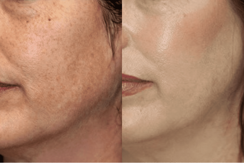 Laser for Pigmentation Treatment