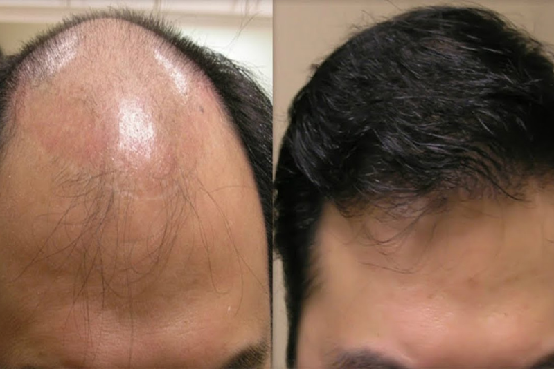 Male/Female Pattern Baldness Treatment