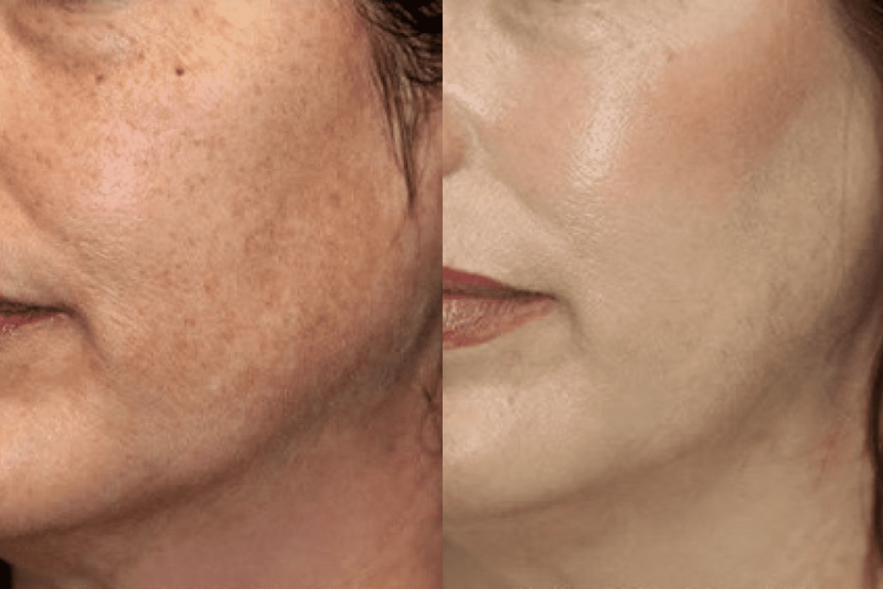 Mesotherapy Treatment