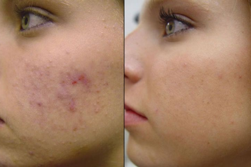 Microneedling (Dermaroller) Treatment