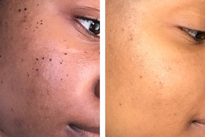 Mole, Wart & Skin Tag Removal Treatment