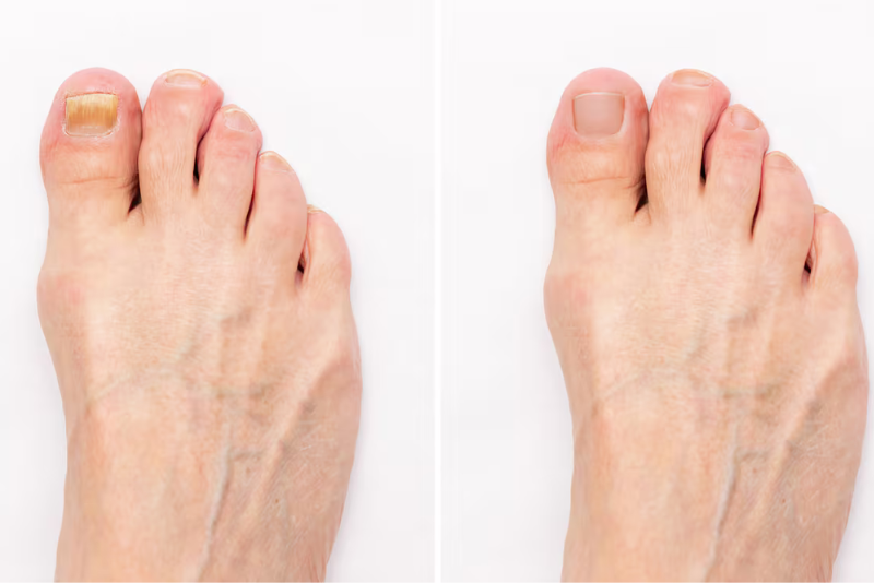 Nail Fungal Infections Treatment