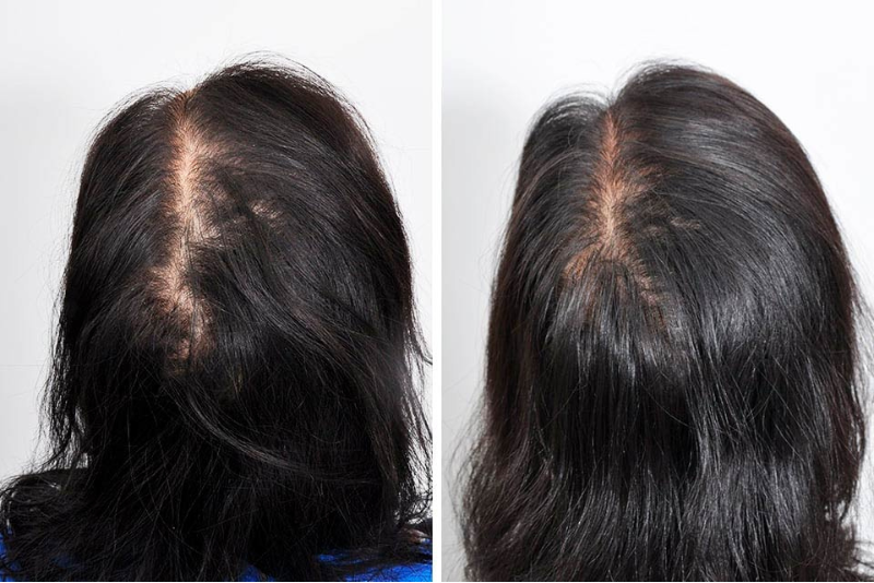 PRP Therapy for Hair Treatment