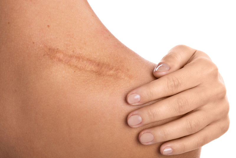 Scar Revision Treatment