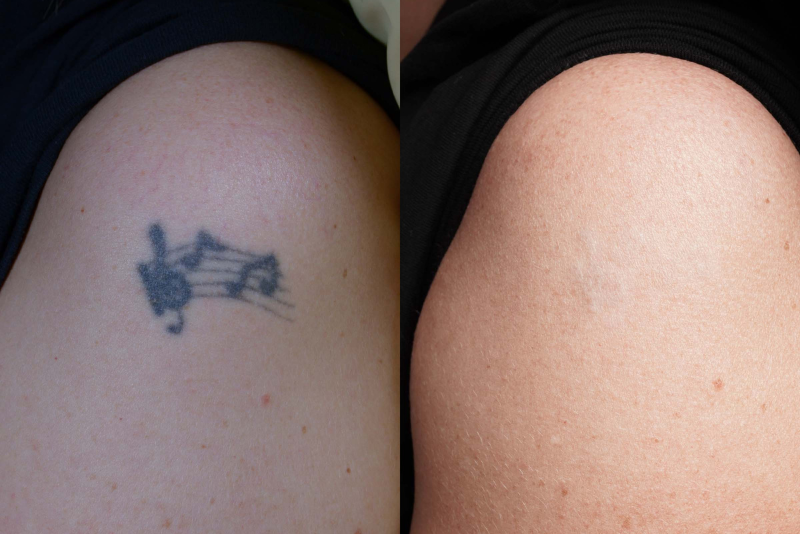 Tattoo Removal Treatment