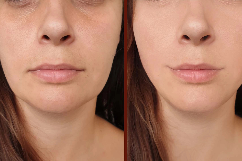 Thread Lift Treatment