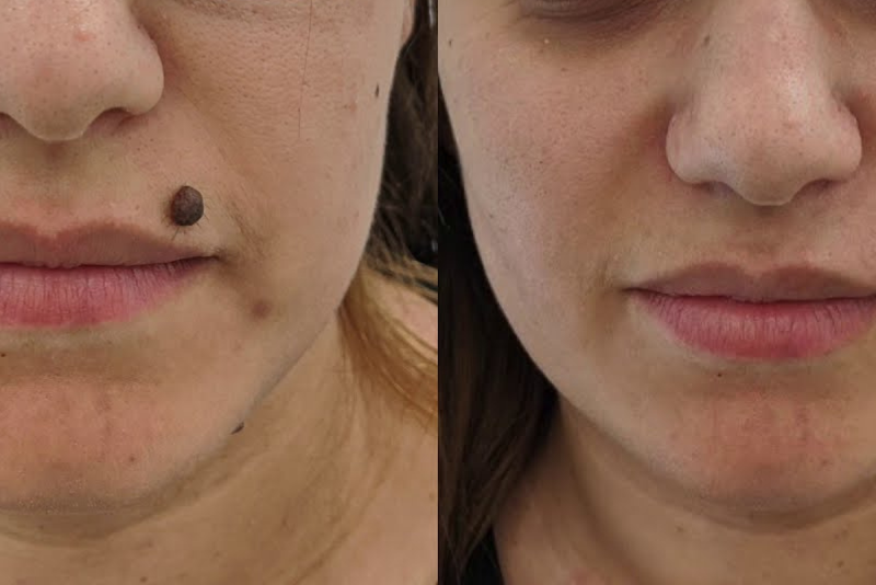 Warts, Moles, Skin Tags Removal